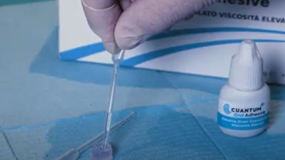 Situații utilizare pentru Cuantum Oral Adhesive și Cuantum Light Curing Oral Adhesive
