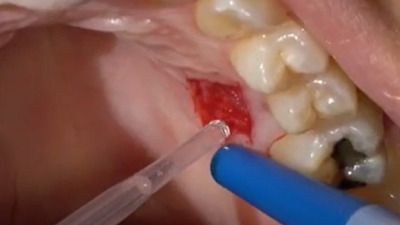 Utilizarea cianoacrilatului în chirurgia orală