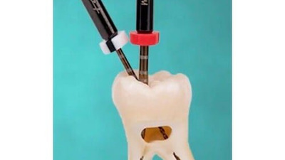 Ace de endodonție DENTAC: performanță și durabilitate în tratamentul de canal