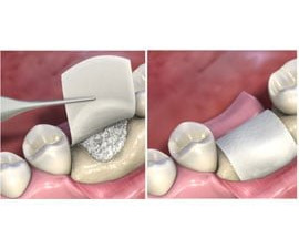 "Membranele de colagen: solutia moderna pentru tratamente dentare"