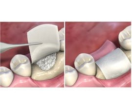 "Membranele de colagen: solutia moderna pentru tratamente dentare"