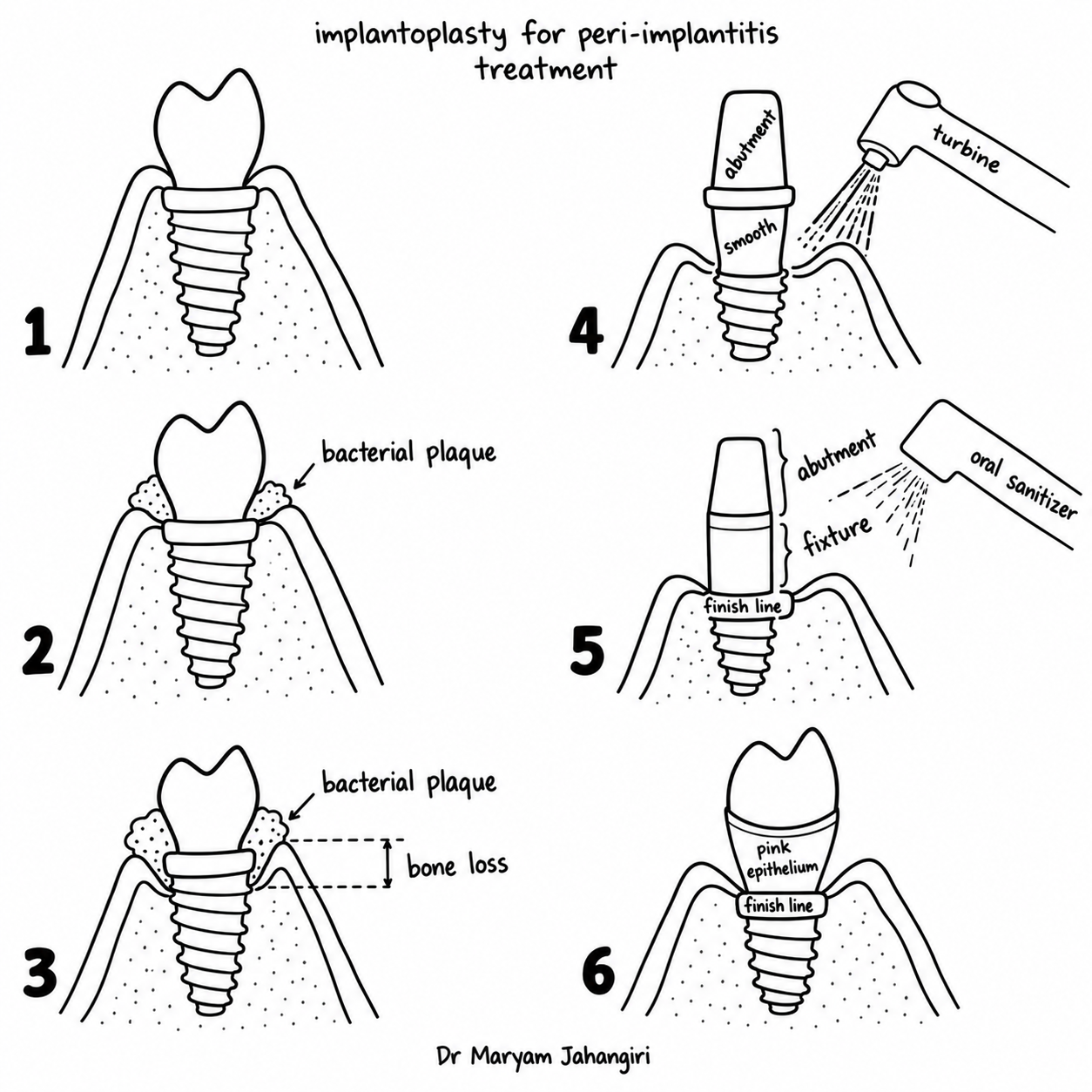 Management peri-implantar