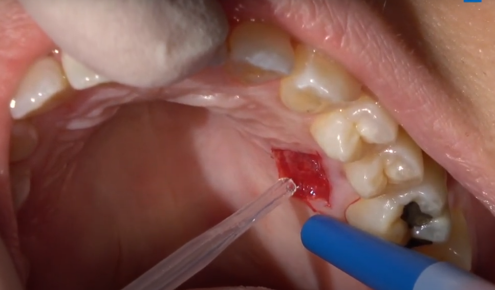 Adeziv Oral Cianoacrilat