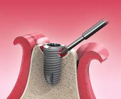 TI-BRUSH (Titanium Brush)