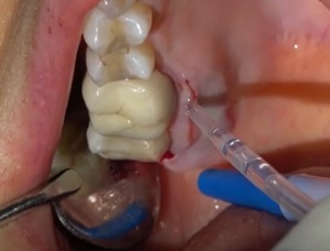 Cuantum Oral Adhesive – Adeziv tisular autopolimerizabil pentru chirurgie orală | Invictus Medical - Img 10