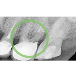 Healvisco Dental – Gel cu Acid Hialuronic pentru Vindecare, Implantologie și Regenerare (Sticky Bone & GBR) - Img 9