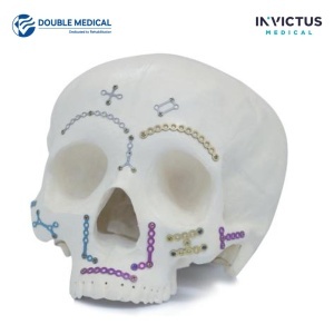 Plăci KALEIDO Midface 1,5 Double Medical, exemplu de poziționare pe craniu