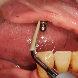 Rezerve de vârf Scorpion Ultrasonic CLiP PEEK – 5 bucăți - Img 4