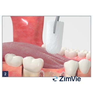 ZimVie Collagen Plug – Hemostatic și suport pentru vindecare, pachet 10 bucăți - Img 4