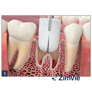ZimVie Collagen Plug – Hemostatic și suport pentru vindecare, pachet 10 bucăți - Img 5