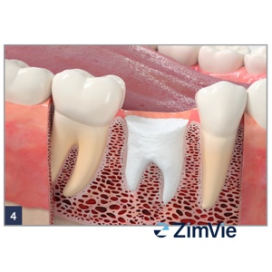 Dop Hemostatic Resorbabil ZimVie Collagen Plug (0102Z) – 10 buc. - Img 5