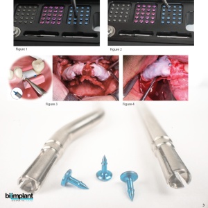 GBR KIT - All in One (TORX) - Set complet cu pini și șuruburi de osteosinteză - Img 2
