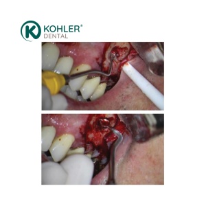 3305 – Instrument Țesut Granulație 2 mm Dr. Sabeti PEEK Yellow – KOHLER Dental – Versiune Scurtă și Lungă - Img 2