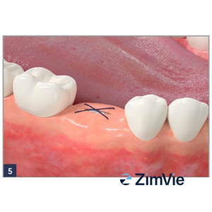 Dop Hemostatic Resorbabil ZimVie Collagen Plug (0102Z) – 10 buc. - Img 6
