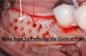 Microfreză pentru Corticotomie și Perforații Corticale Ø 0.90 mm cu Stop 4 mm - K-10-852-04NK - Img 2