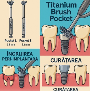Titanium Brush Dental Studio – Perie Titan pentru Decontaminare Implanturi în Tratamentul Peri-implantitei - Img 6