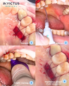 Cuantum Light Curing Oral Adhesive – Adeziv Tisular Fotopolimerizabil pentru Parodontologie și Sigilare Plăgi, 10 × 1 g - Img 2
