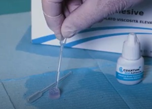 Cuantum Oral Adhesive – Adeziv Tisular Cianoacrilat Autopolimerizabil pentru Chirurgie Orală și Hemostază, 5g - Img 3