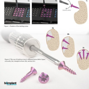 GBR KIT - All in One (TORX) - Set complet cu pini și șuruburi de osteosinteză - Img 3