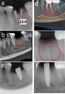 Ivory Dentin Graft – material de adiție din dentină, în godeu (0,5 g / 1 g / 2 g) - Img 3