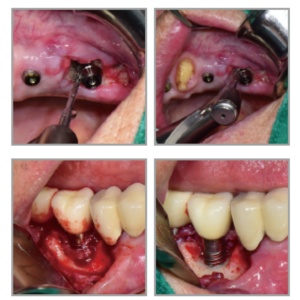 Titanium Brush For Peri-Implantities Pocket - curățare profundă a pungilor peri-implantare - DENTAL STUDIO - Img 4