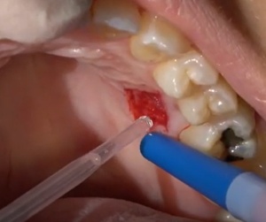 Cuantum Oral Adhesive – Adeziv tisular autopolimerizabil pentru chirurgie orală | Invictus Medical - Img 6