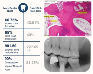 Ivory Dentin Graft – material de adiție din dentină, în seringă (1 g) - Img 4