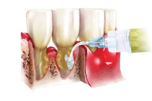Perio-Flush Kit ( 10 × 3 ml ) – Soluție profesională pentru irigarea pungilor parodontale - ARKONA - Img 8