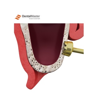 Trusă Sinus Lift – Freze și Separatoare pentru Abordare Crestală și Laterală (Sinus Lift Kit) - Dental Master - Img 7