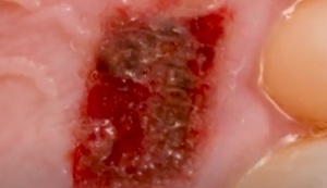 Cuantum Oral Adhesive – Adeziv Tisular Cianoacrilat Autopolimerizabil pentru Chirurgie Orală și Hemostază, 5g - Img 4