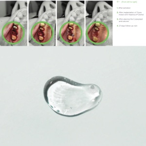 Healvisco Dental – Gel cu Acid Hialuronic pentru Vindecare, Implantologie și Regenerare (Sticky Bone & GBR) - Img 8