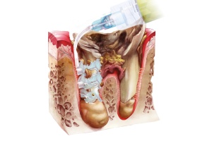 Perio-Flush Kit ( 10 × 3 ml ) – Soluție profesională pentru irigarea pungilor parodontale - ARKONA - Img 9