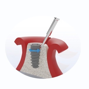 Titanium Brush pentru Implanturi Dentare – Perie pentru Decontaminare în Tratamentul Peri-implantitei - Img 3