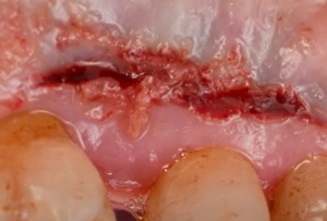 Cuantum Oral Adhesive – Adeziv tisular autopolimerizabil pentru chirurgie orală | Invictus Medical - Img 8