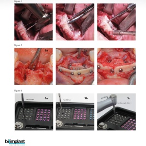 GBR KIT - All in One (TORX) - Set complet cu pini și șuruburi de osteosinteză - Img 4