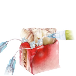 Perio-Flush Kit ( 10 × 3 ml ) – Soluție profesională pentru irigarea pungilor parodontale - ARKONA - Img 3