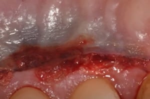 Cuantum Oral Adhesive – Adeziv tisular autopolimerizabil pentru chirurgie orală | Invictus Medical - Img 9