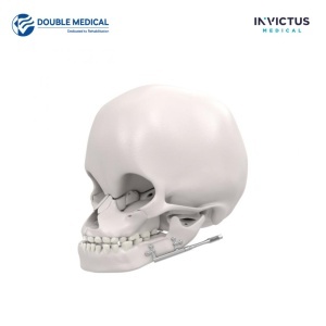 Distractor mandibular KALEIDO Double Medical poziționat pe mandibulă