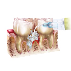 Perio-Flush Kit ( 10 × 3 ml ) – Soluție profesională pentru irigarea pungilor parodontale - ARKONA - Img 5