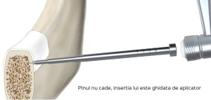 PinJect Set - Sistem manual de mare precizie pentru aplicarea pinilor - Img 7