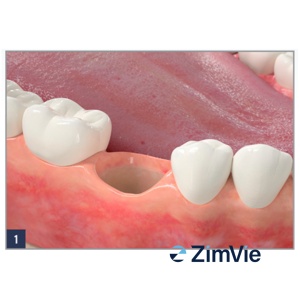 ZimVie Collagen Plug – Hemostatic și suport pentru vindecare, pachet 10 bucăți - Img 3