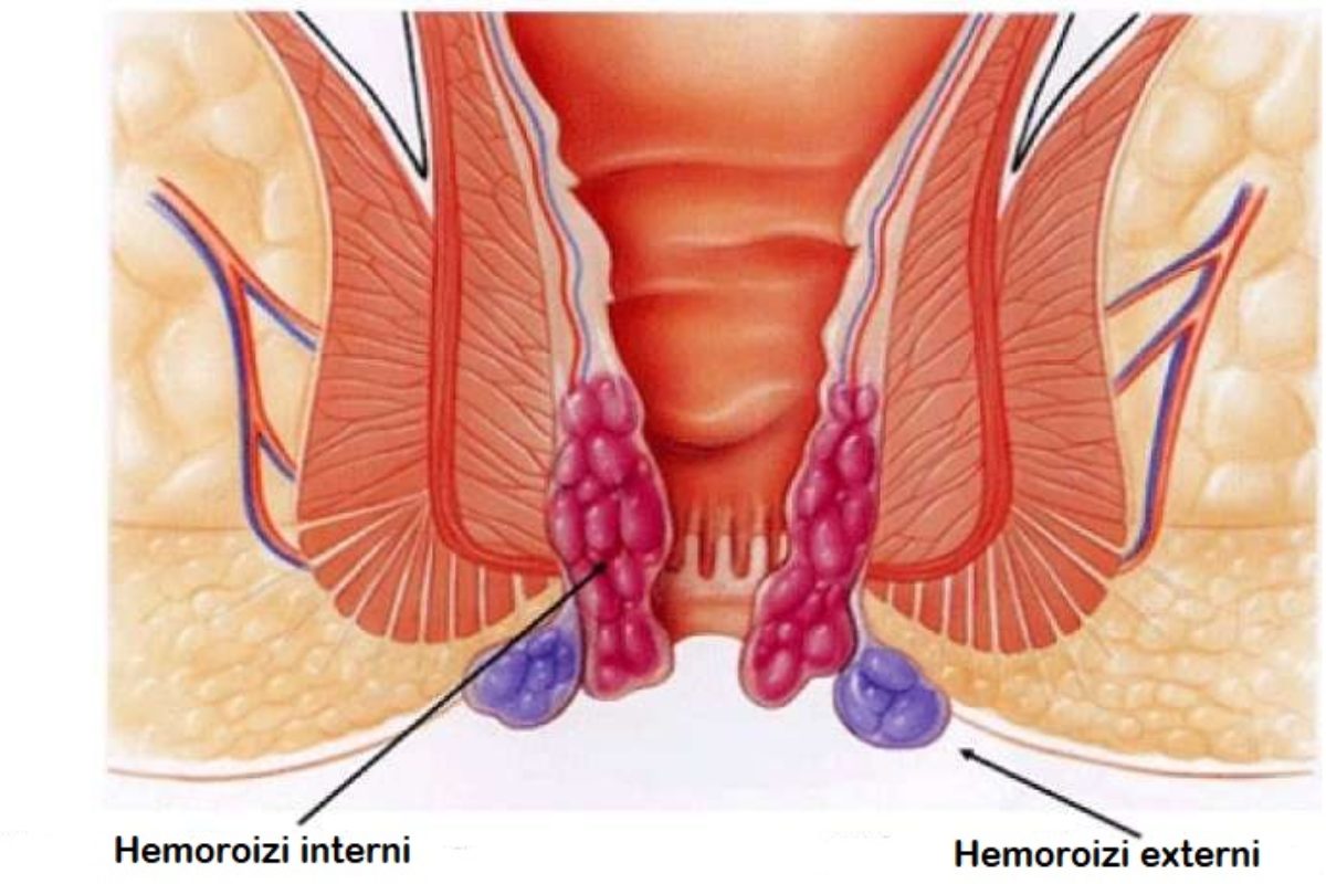 Hemoroizi