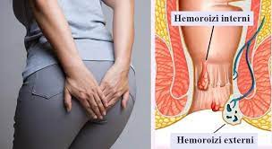 Hemoroizi