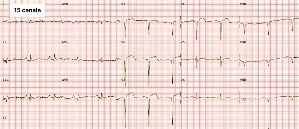 Electrocardiograma cu 15 canale - Medicalcorp.ro