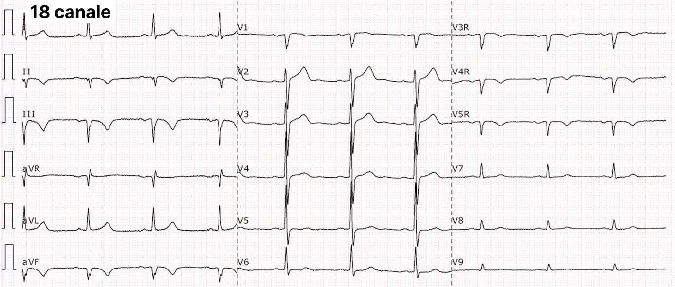 Electrocardiograma cu 18 canale - Medicalcorp.ro