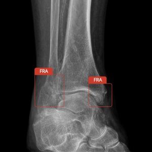 Software diagnostic - CAREBOT AI BONES pentru Sistem Osos
