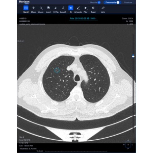 Software diagnostic HORIZON by CAREBOT AI CT LUNGS