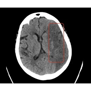 Software diagnostic cerebral CAREBOT AI HEAD CT - BRAIN CT