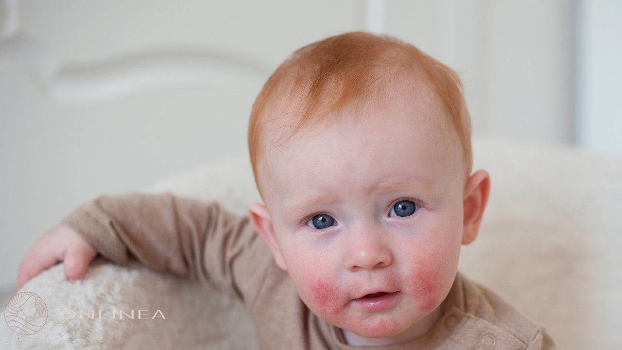 Atopijski dermatitis: simptomi, lečenje i kreme
