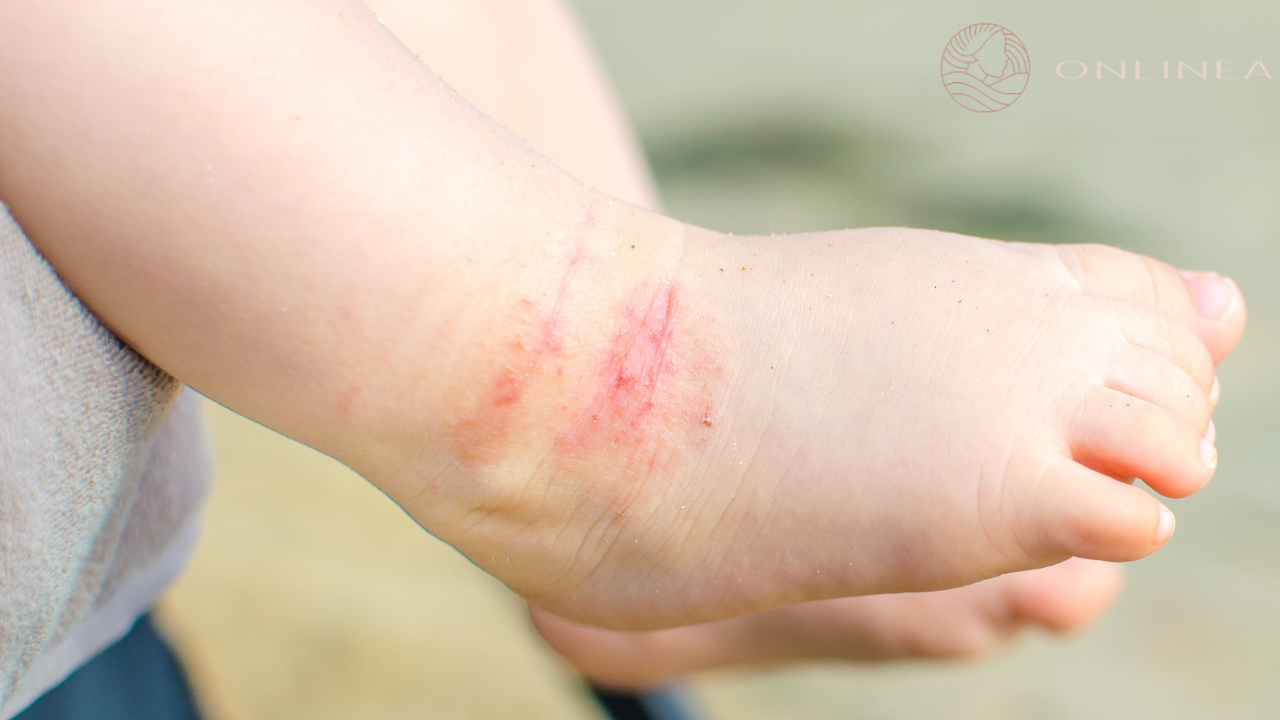 Atopijski dermatitis: simptomi, leenje i kreme | Apoteka Onlinea
